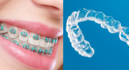 Braces & Aligners - Vats & Param