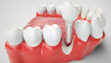 Dental Implants - Vats & Param