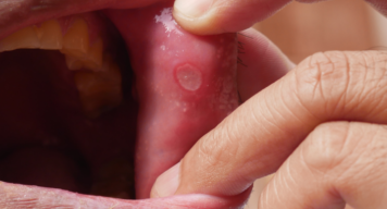 Mouth Ulcers - Vats and Param