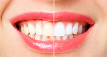 Teeth Whitening - Vats & Param