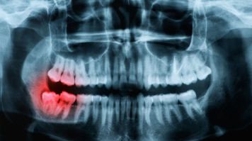 Wisdom Teeth Removal - Vats & Param